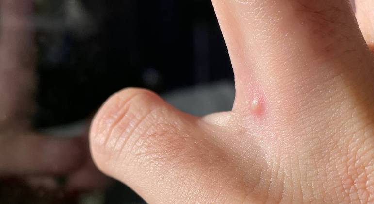 Varíola dos macacos (Foto: Divulgação)