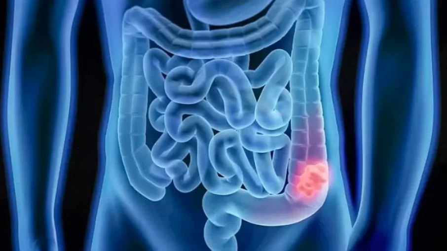 Pela primeira vez tratamento elimina câncer em todos os pacientes